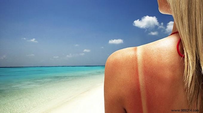 An Amazing Sunburn Remedy You ll Love. 