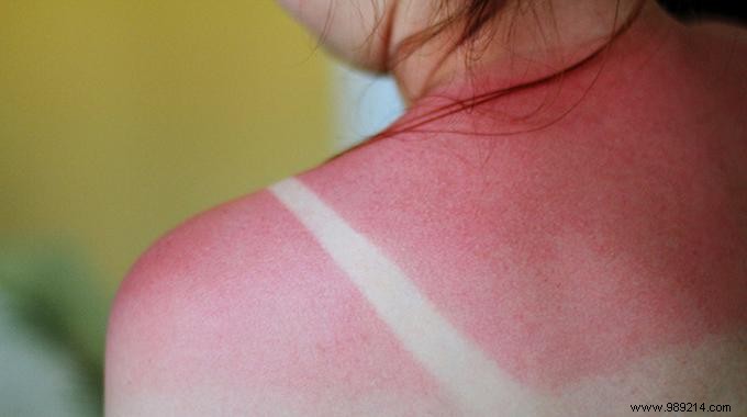 The Natural Remedy that Soothes Sunburn. 