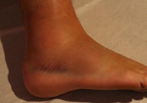 Grandma s Proven Remedy: Garlic and Olive Oil for Fast Sprain Relief