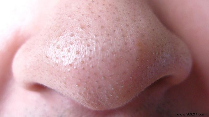 Trick to Remove Blackheads Easily. 