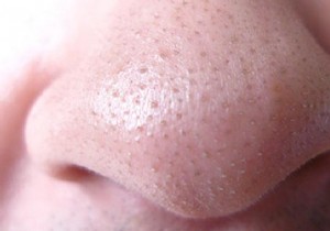 Trick to Remove Blackheads Easily. 