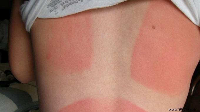 3 Effective Solutions to Relieve a Sunburn. 