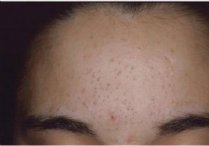 The Effective Remedy To Cure Blackheads Naturally. 