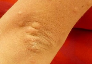 The Magic Remedy to Relieve Insect Bites. 