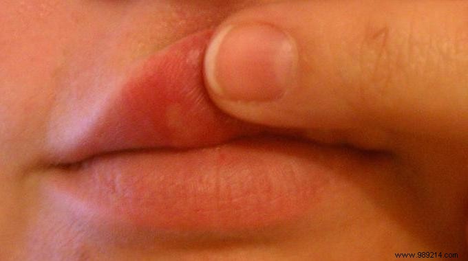 The Secret Remedy To Make A Cold Sore On The Lip Disappear. 