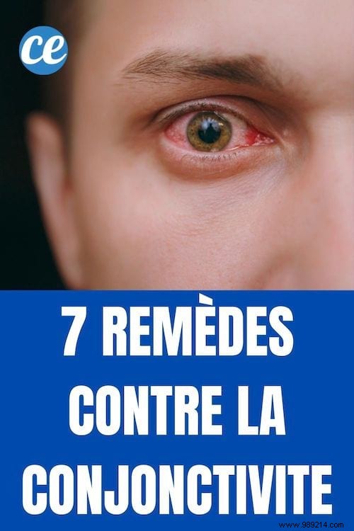 The 7 Remedies to Cure Conjunctivitis Naturally and Quickly. 