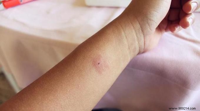 33 Incredibly Effective Remedies To Soothe A Mosquito Bite. 