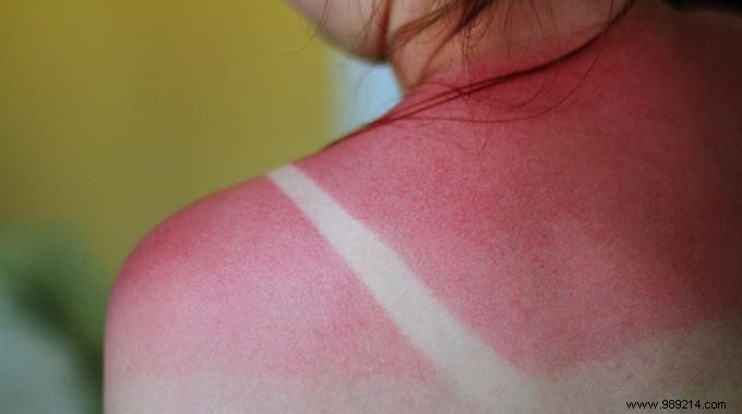 12 Surprising Tips to Relieve Your Sunburns. 