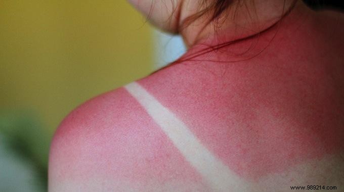 The Unknown Remedy To Cure A Sunburn Easily 