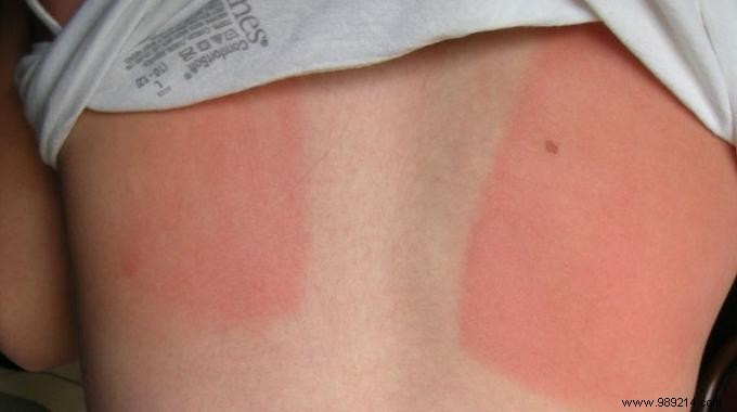 5 Natural Remedies To Soothe Sunburns. 