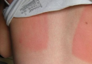 5 Natural Remedies To Soothe Sunburns. 