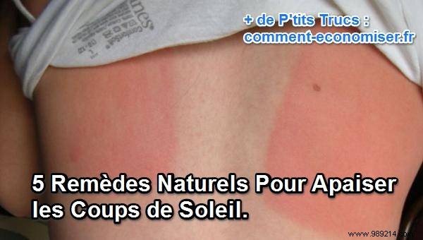5 Natural Remedies To Soothe Sunburns. 