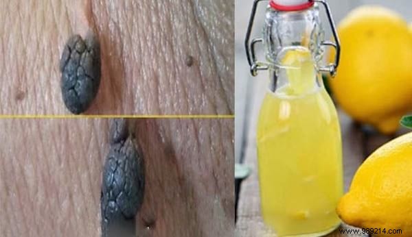 7 Fantastic Remedies To Get Rid Of Skin Tags. 