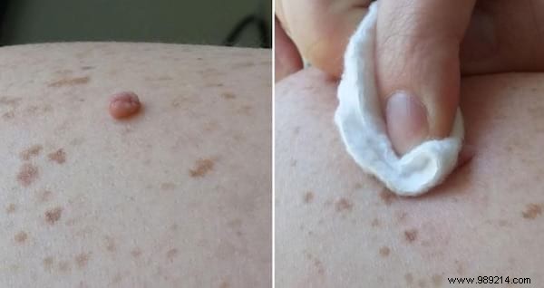 7 Fantastic Remedies To Get Rid Of Skin Tags. 