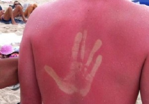 THE Unsuspected Food to Relieve a Sunburn. 