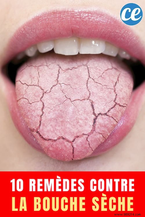 10 Simple And Effective Remedies For Dry Mouth. 