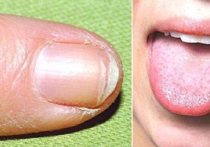 9 Signs That Show You Are Lacking Iron (And Our Tips For Resolving Them). 