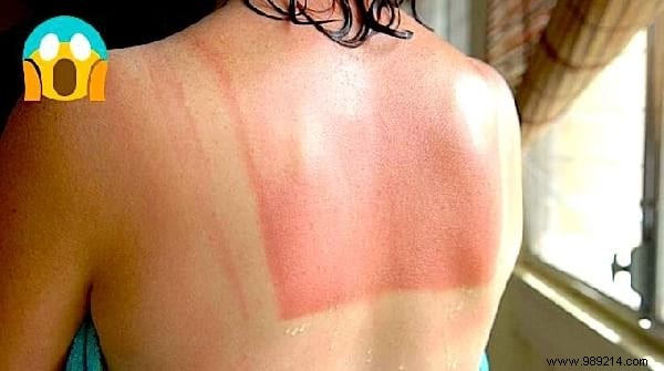 15 Natural Remedies To Relieve A Sunburn WITHOUT Biafine. 
