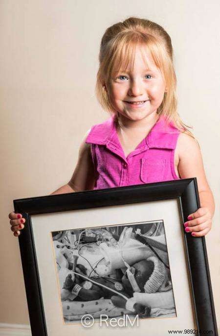 17 Photos of Premature Babies Who Hold Photo Two When They Were Babies. 