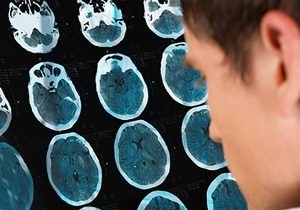 Long-Term Stroke Effects: 70% of Survivors Face Lasting Cognitive and Behavioral Changes