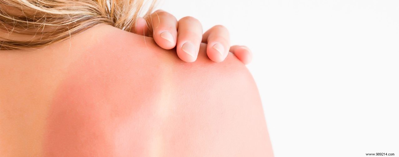 4 ways to take care of your sunburnt skin 