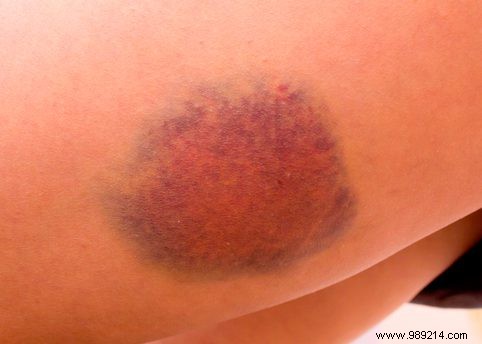 How does a bruise arise? 