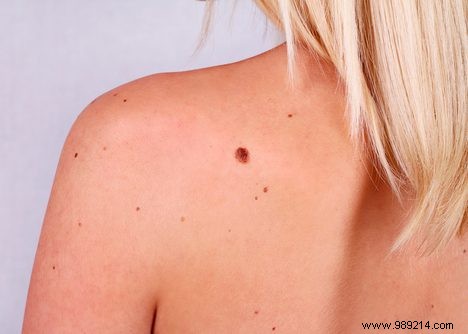 Few moles, less chance of skin cancer? 