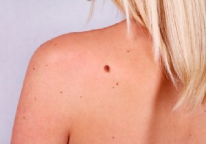 Few moles, less chance of skin cancer? 