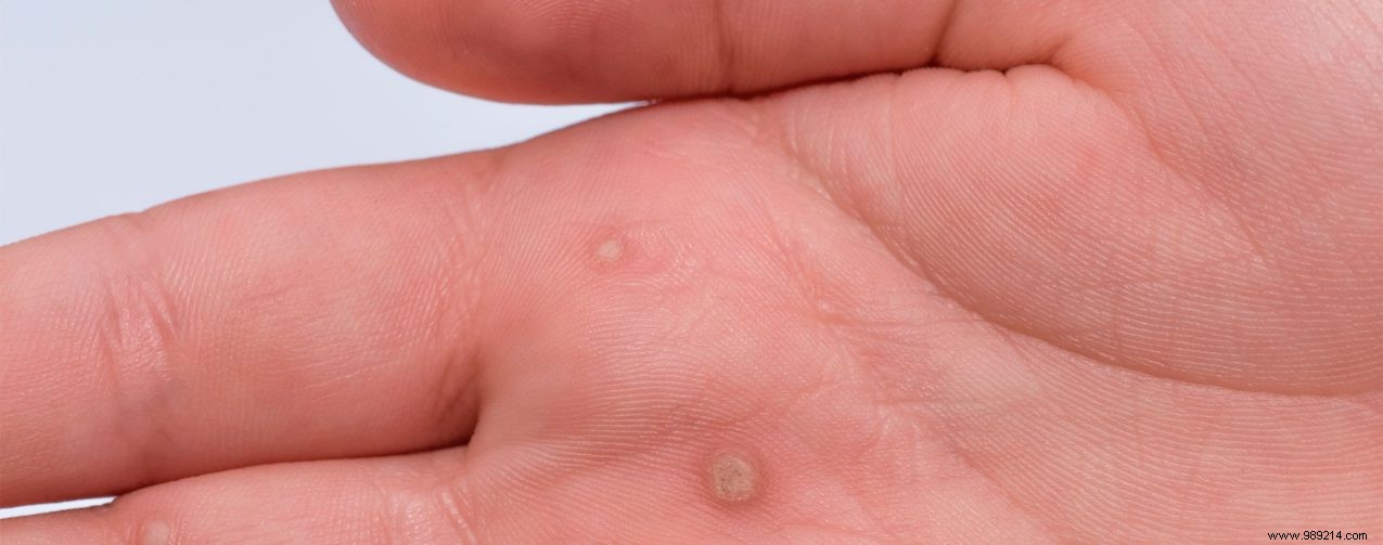 First aid for warts 