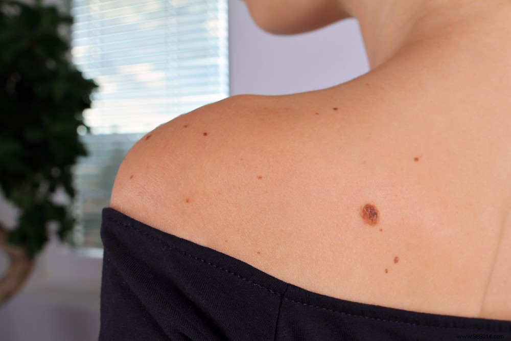 5 tips to check your moles 