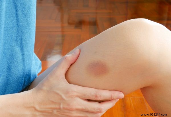 Do women bruise faster than men? 