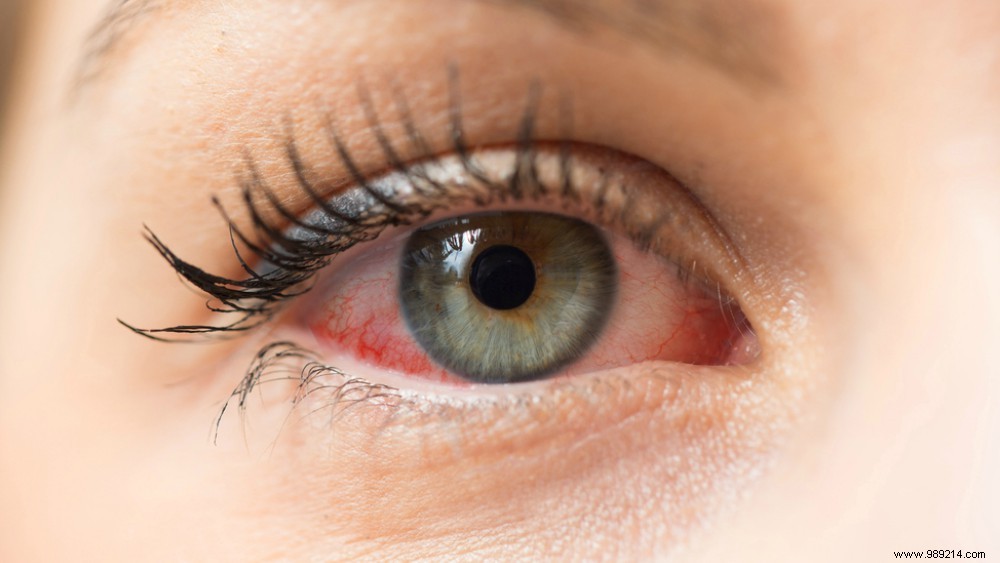 7 Possible Causes of Red Eyes 