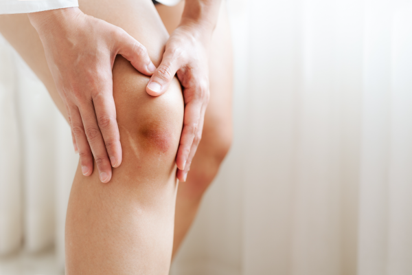 9 reasons why you bruise easily 