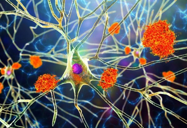 Maastricht scientists make important discovery in the field of Alzheimer s 