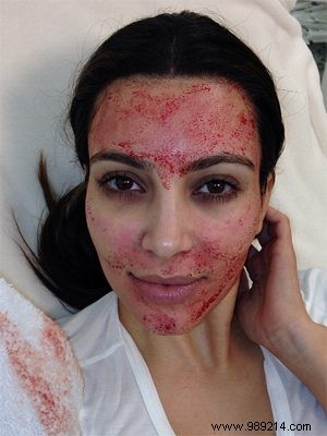 Bizarre beauty treatment:vampire facial 