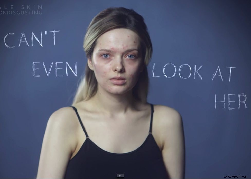 Must-See:Acne &Makeup Video 
