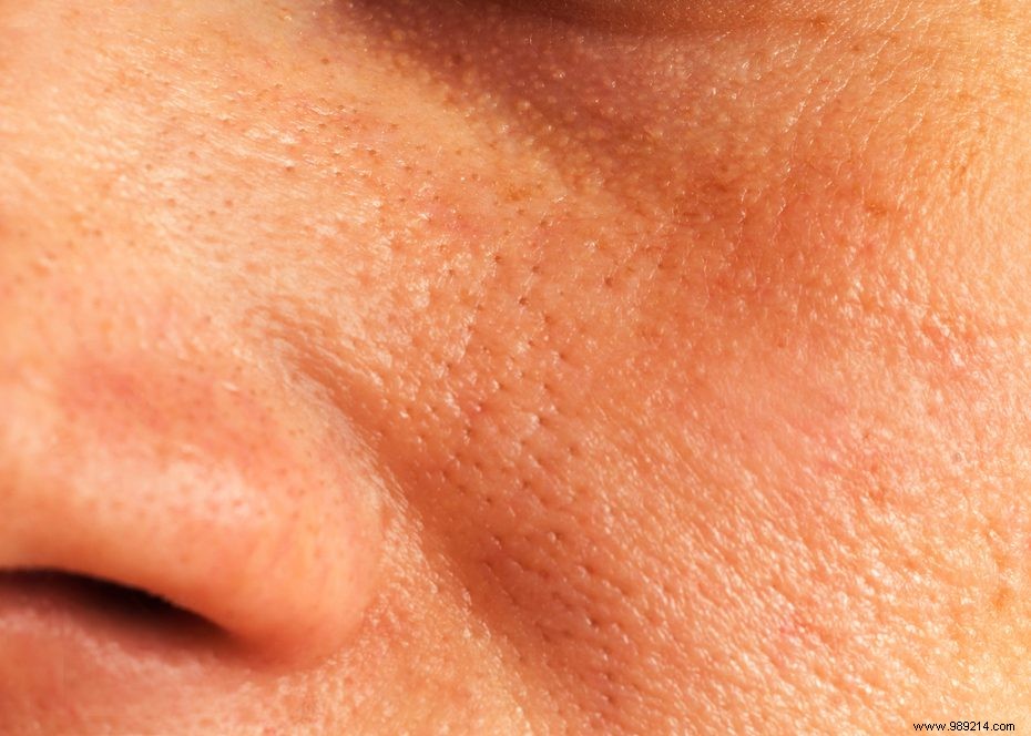 What are coarse pores? 