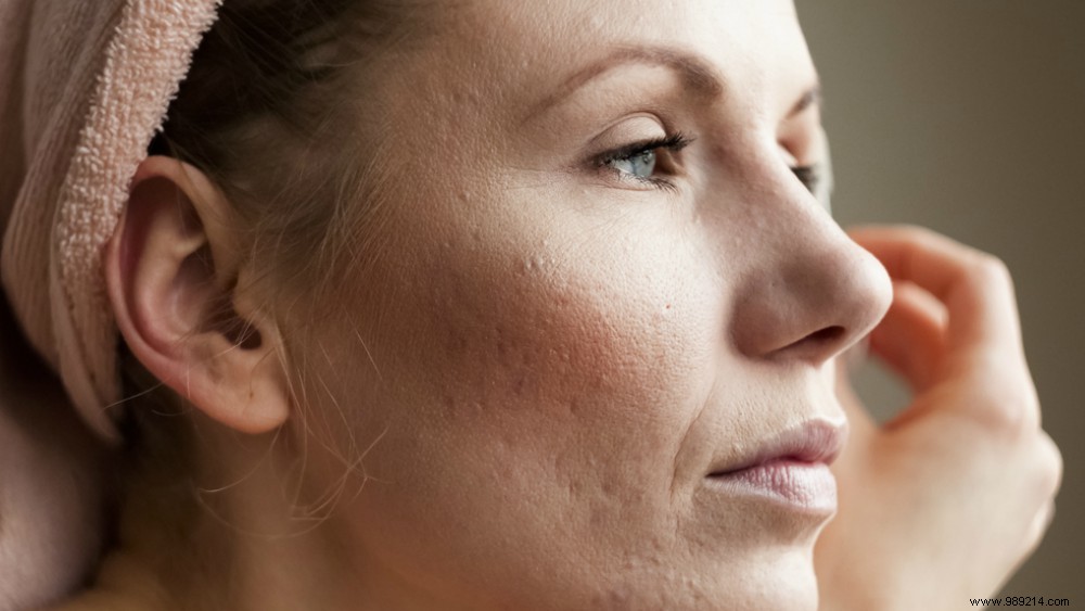 How do you take care of your skin if you suffer from rosacea? 