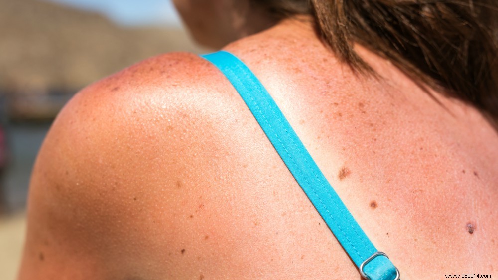 Burned by the sun? How to treat your skin 