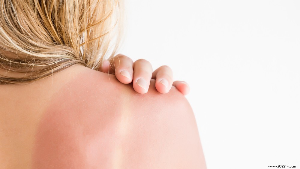 Why does your skin peel when you are burned? 