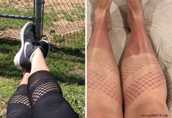 Oops:this is what you can look like if your skin is burned by the sun 