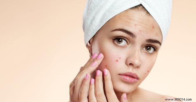 The 8 reflexes to adopt when faced with an acne pimple 