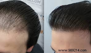 Why is the choice of hair transplant a good idea? 
