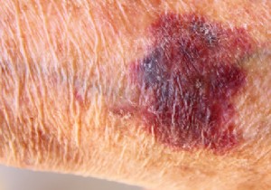 Why do the elderly often have hematomas? 