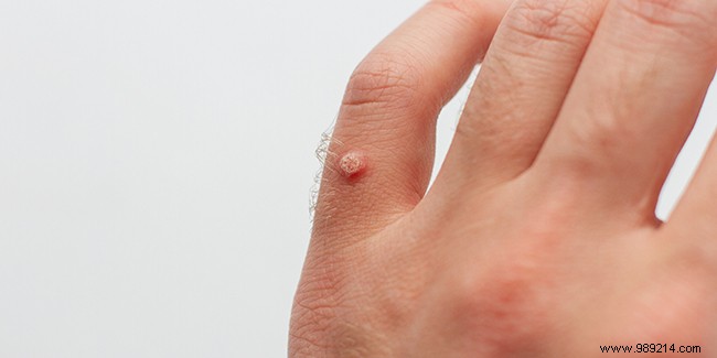 What solutions to permanently get rid of warts? 