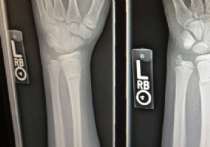 Osteoporosis:cause, symptom, treatment in seniors 