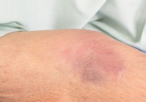 Subdural hematoma in the elderly:explanations 