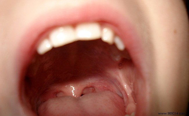 How to treat canker sores with natural remedies? 