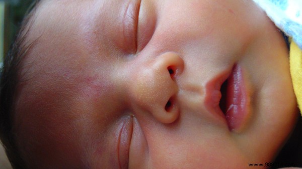 The 3 most common skin problems in babies 