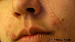 Pimples on the face, the why and how! 